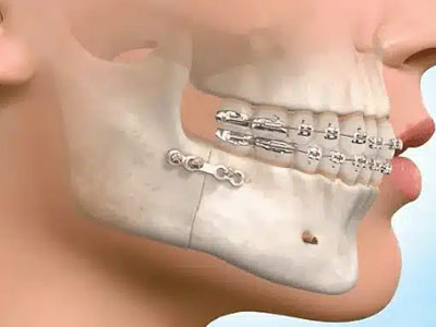 Orthognathic-Surgery
