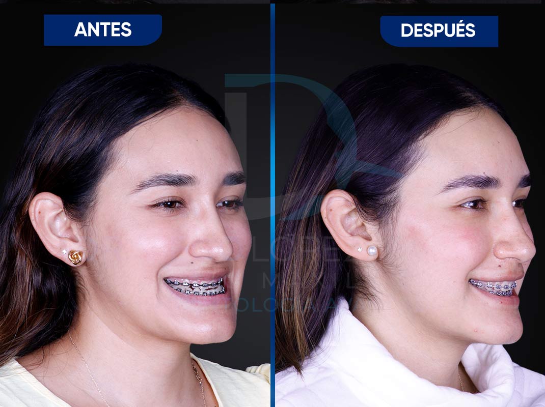 Orthognathic-Surgery2