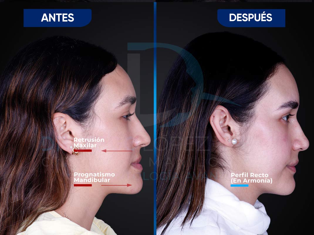 Orthognathic-Surgery3