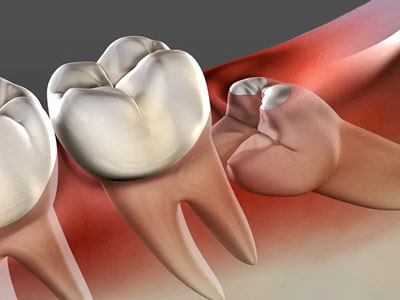 Wisdom Teeth Extractions